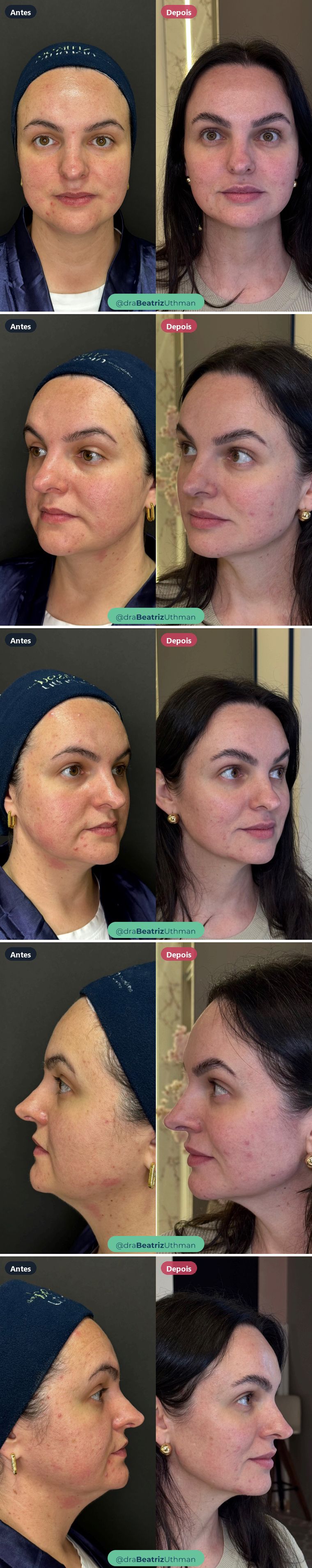 Afinamento facial · 2 anos: antes e depois