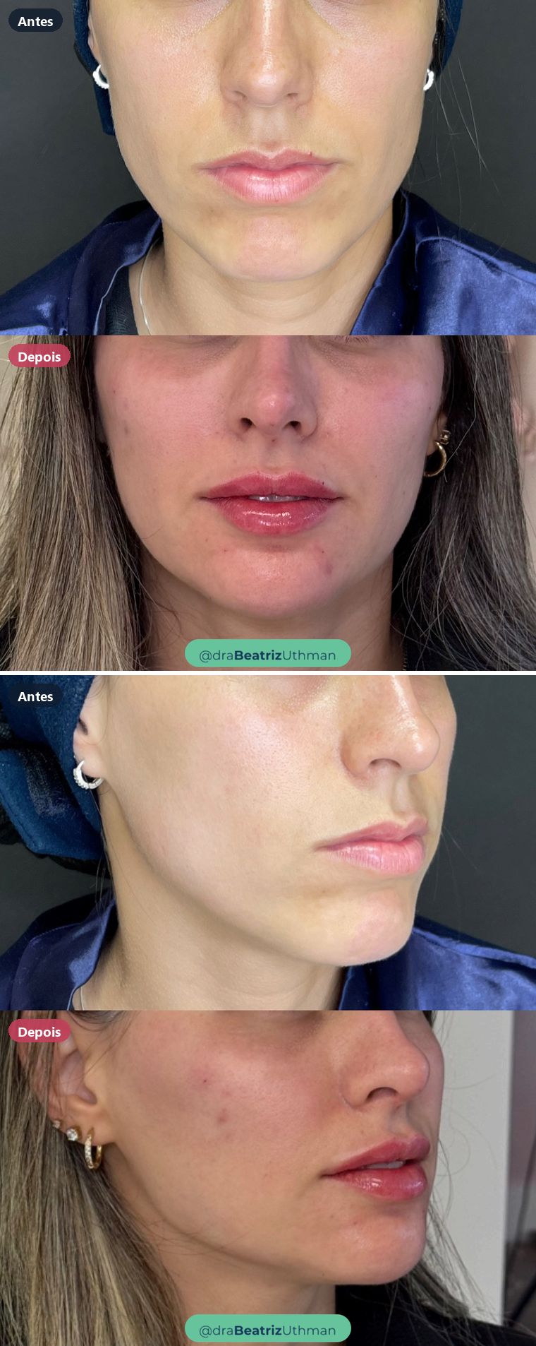 Harmonização · Caso 1: antes e depois