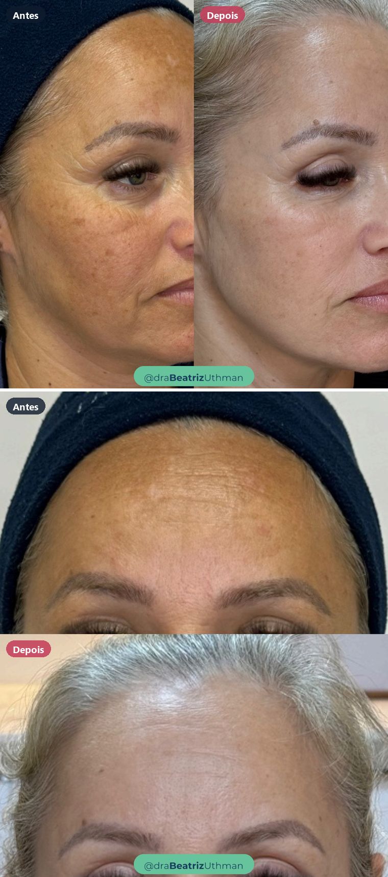 Glasskin · Melasma: antes e depois