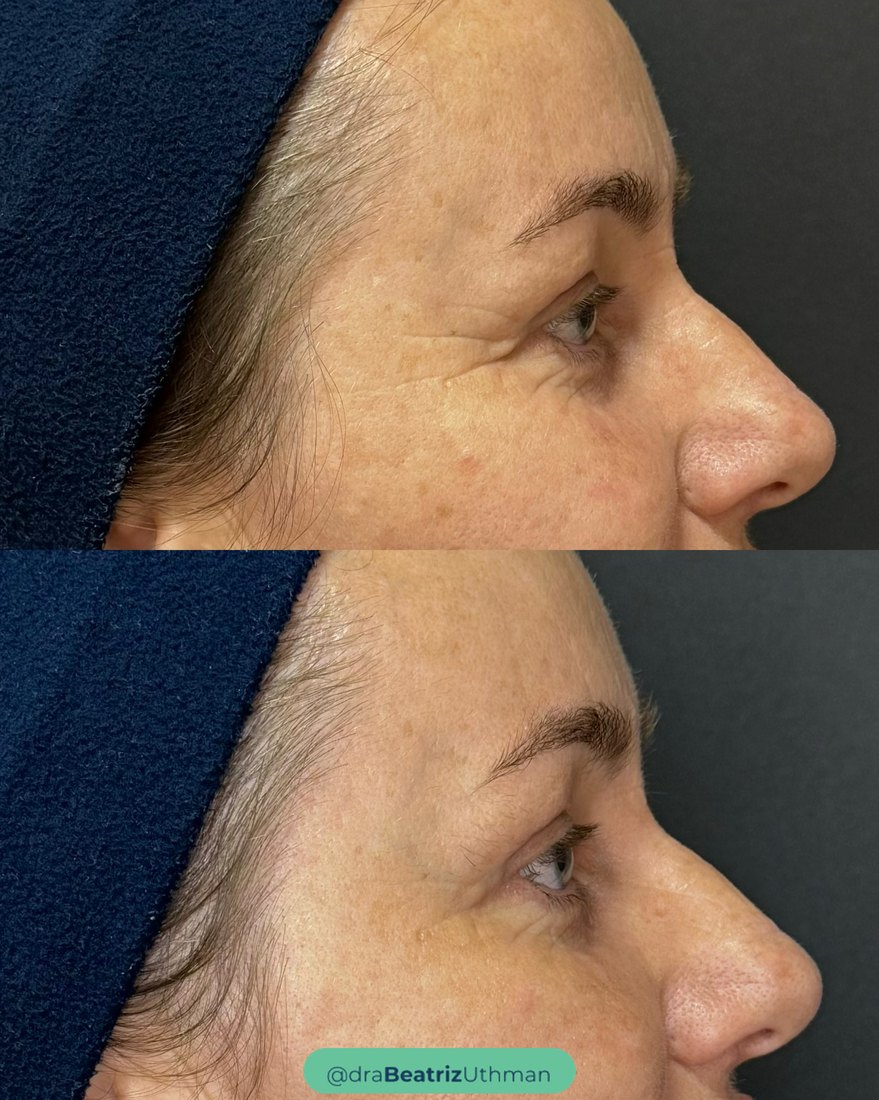 Exo.coll · área dos olhos: antes e depois