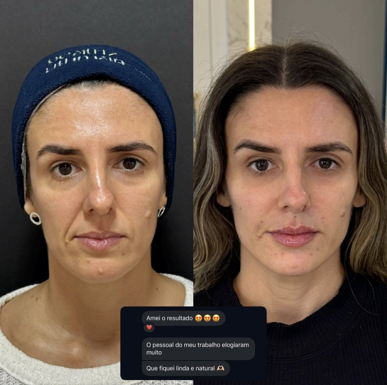 Paciente do consultório antes e depois, com os comentários que ela enviou sobre o resultado