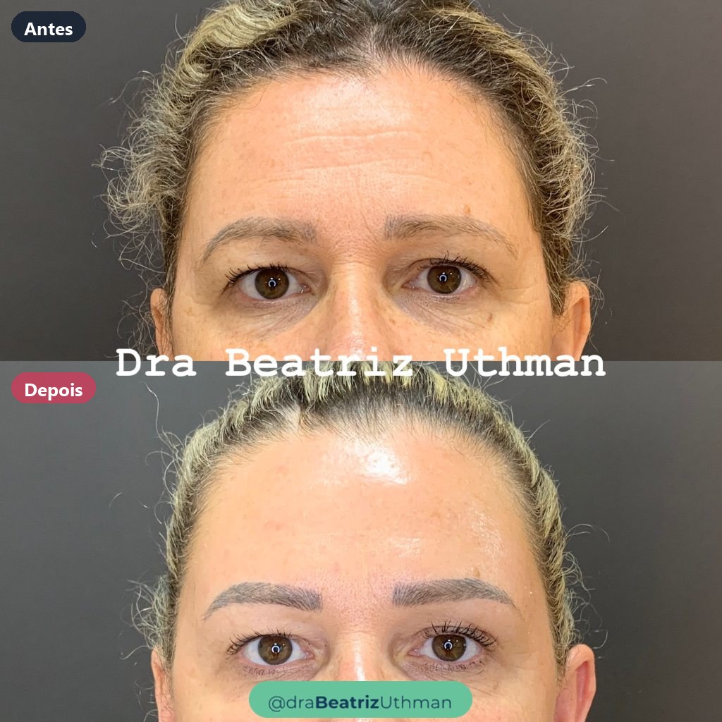 Toxina botulínica · Caso 9: antes e depois