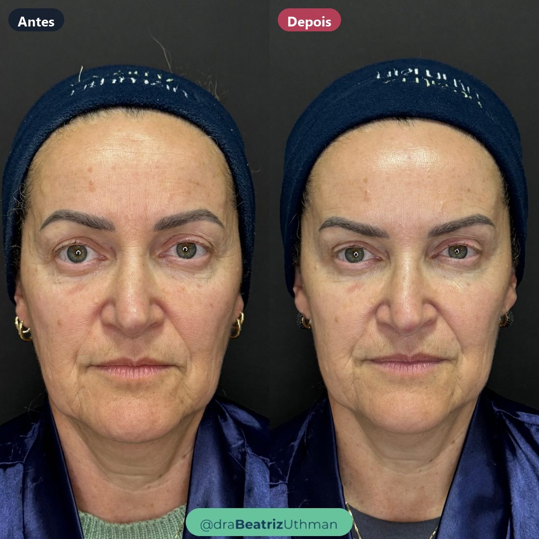Toxina botulínica · Caso 1: antes e depois