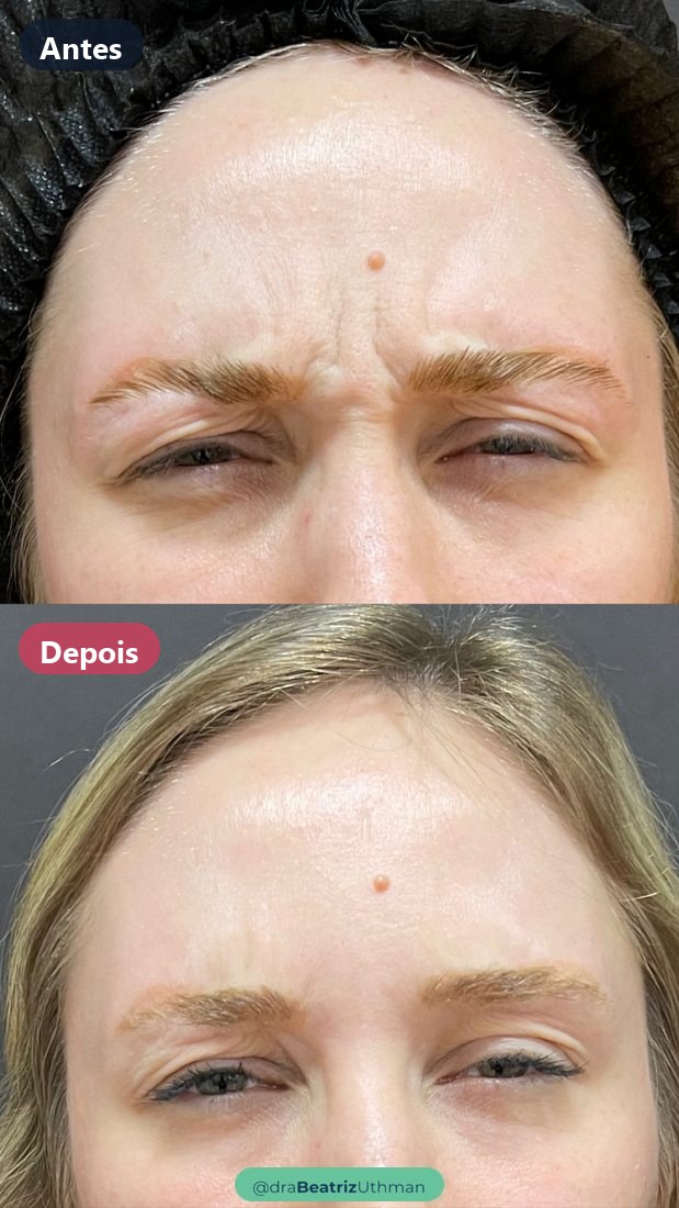 Toxina botulínica · Caso 2: antes e depois