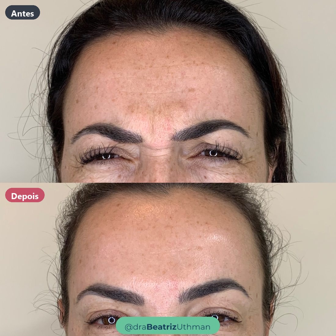Toxina botulínica · Caso 3: antes e depois