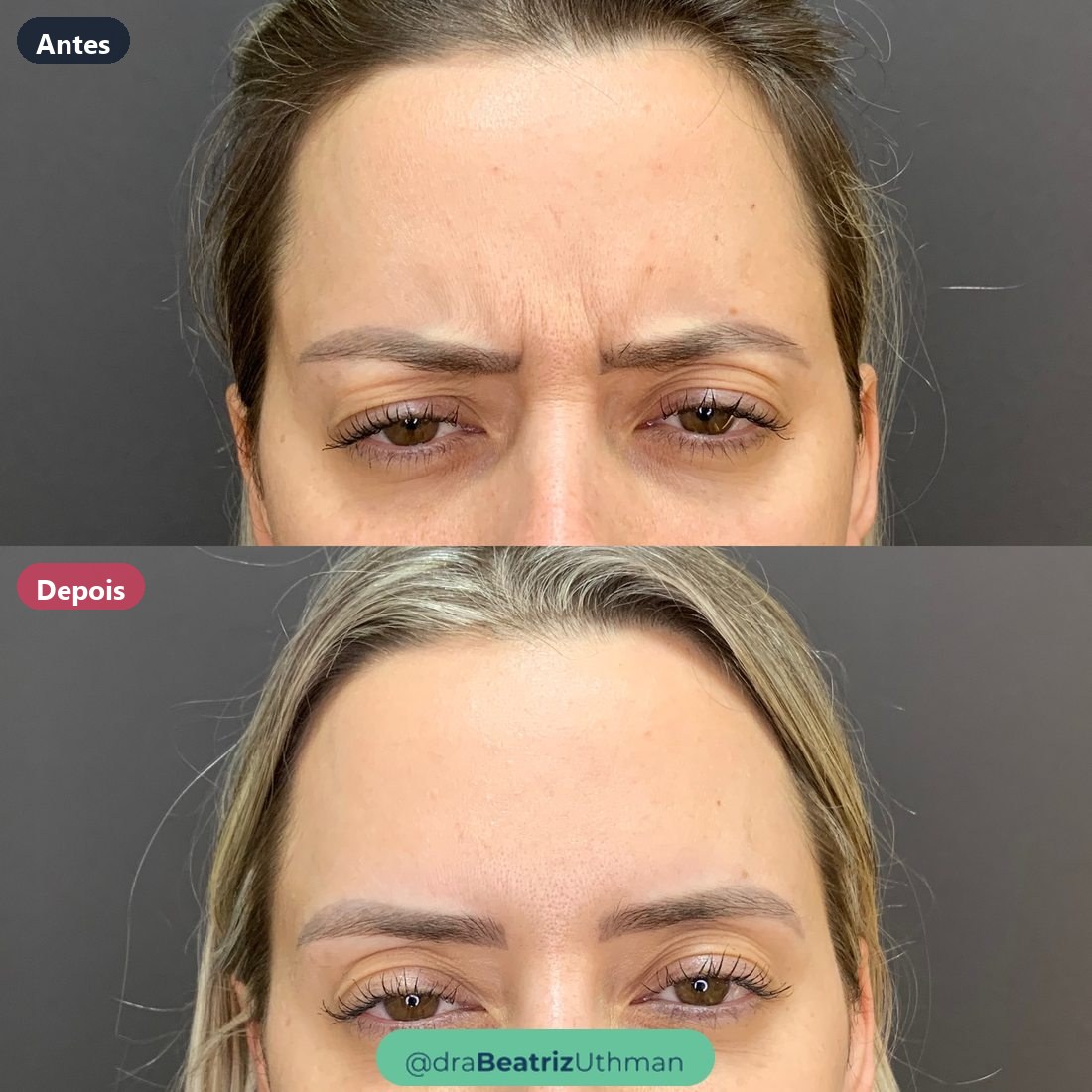 Toxina botulínica · Caso 4: antes e depois