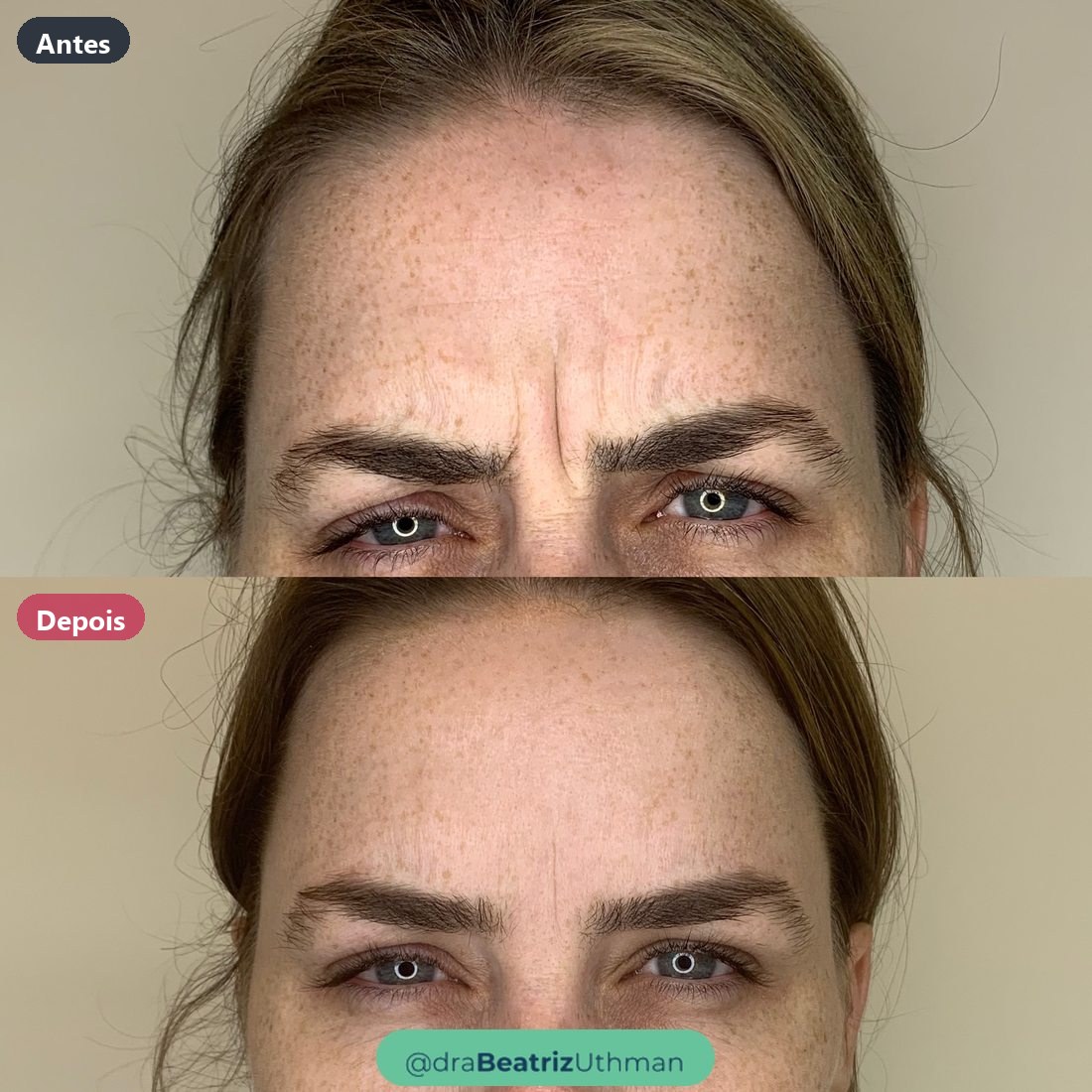 Toxina botulínica · Caso 5: antes e depois