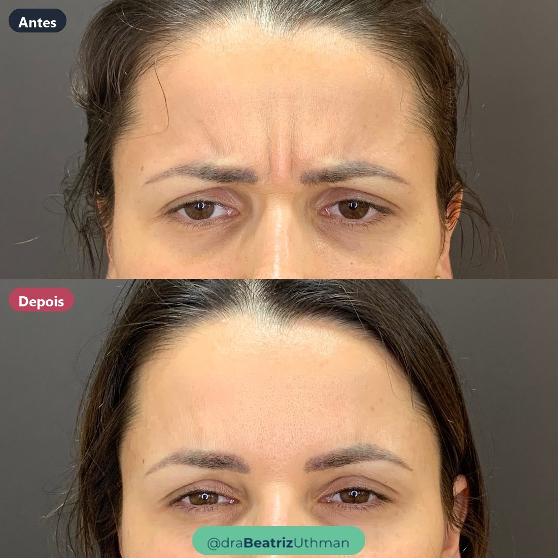 Toxina botulínica · Caso 6: antes e depois