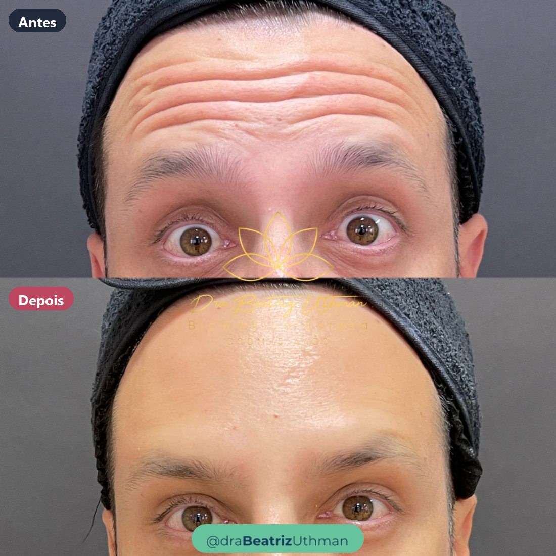 Toxina botulínica · Caso 7: antes e depois
