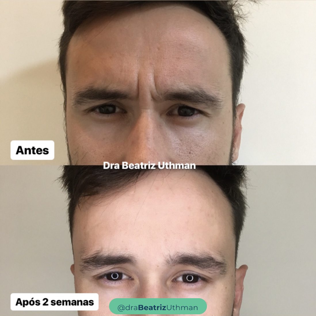 Toxina botulínica · Caso 8: antes e depois