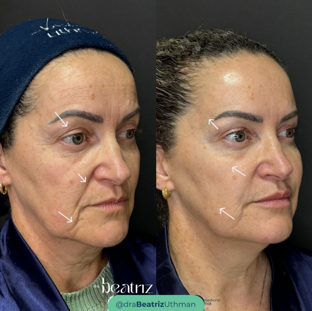 Ultraformer · Caso 2: antes e depois