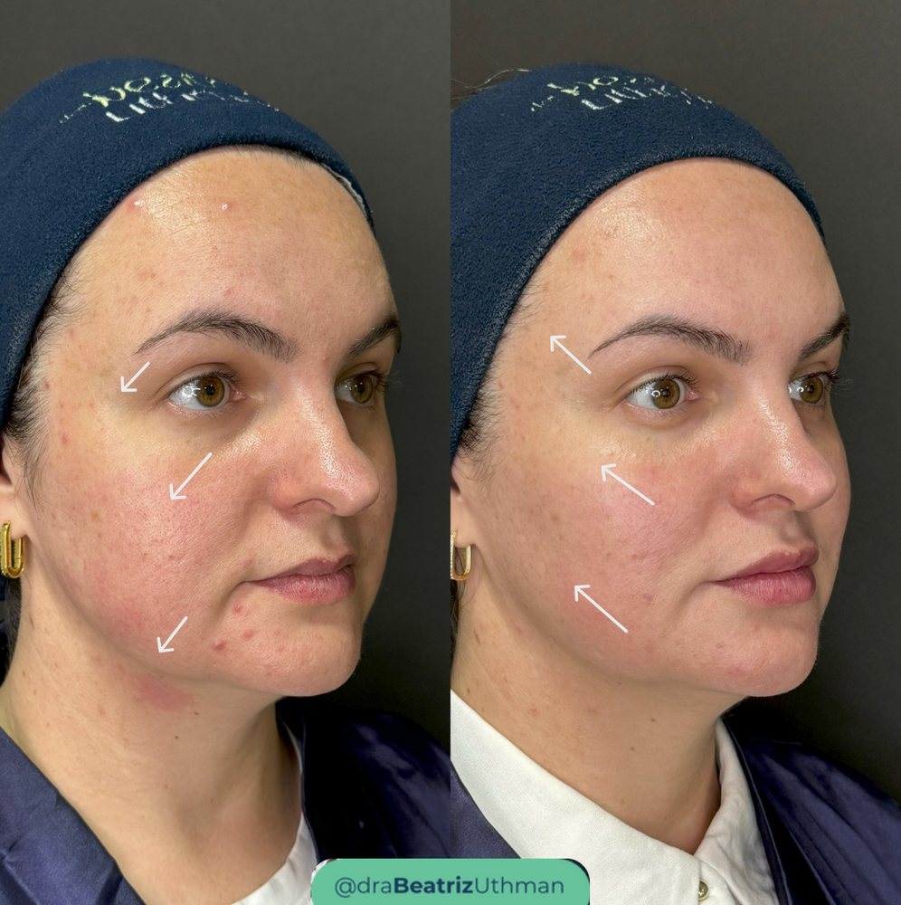 Ultraformer · Caso 3: antes e depois