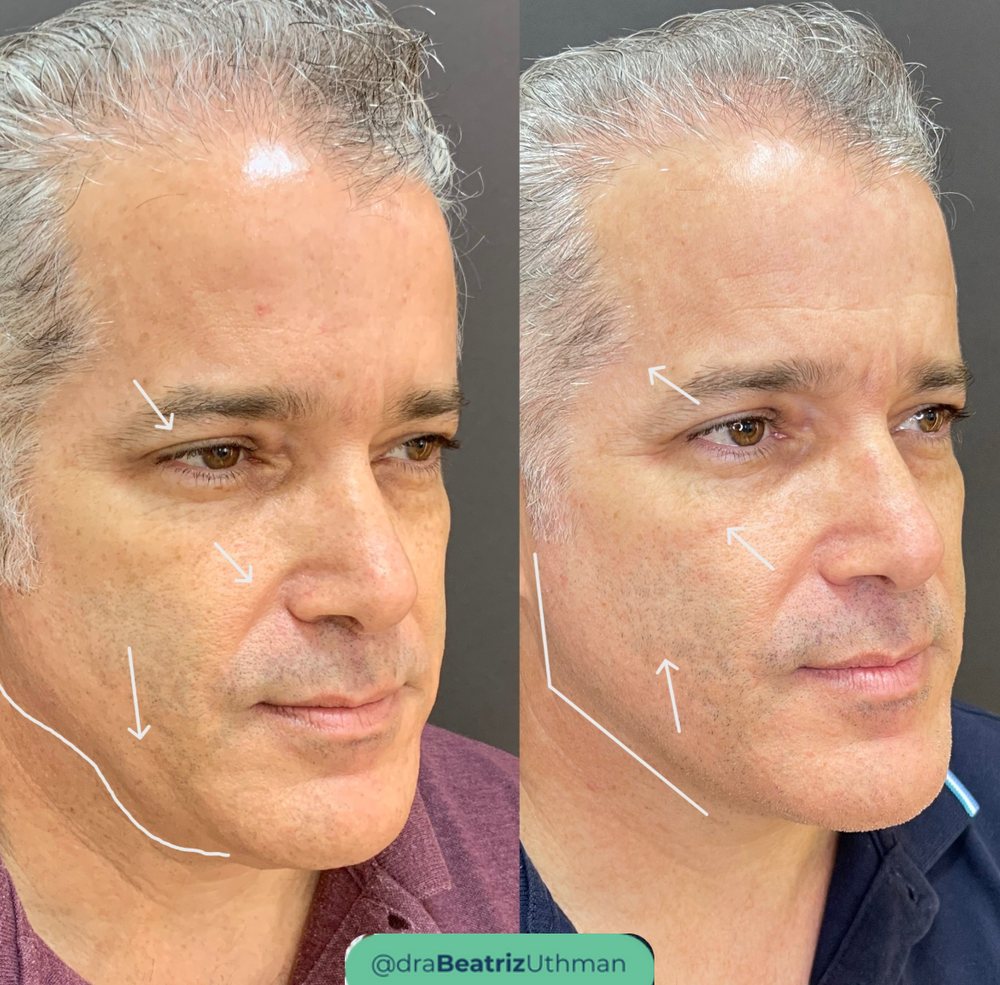 Ultraformer · Caso 4: antes e depois