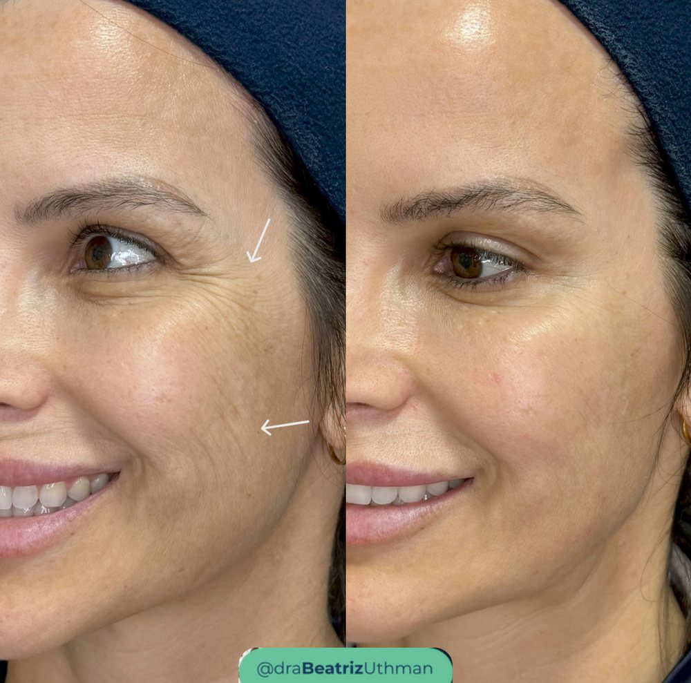 Ultraformer · Caso 5: antes e depois