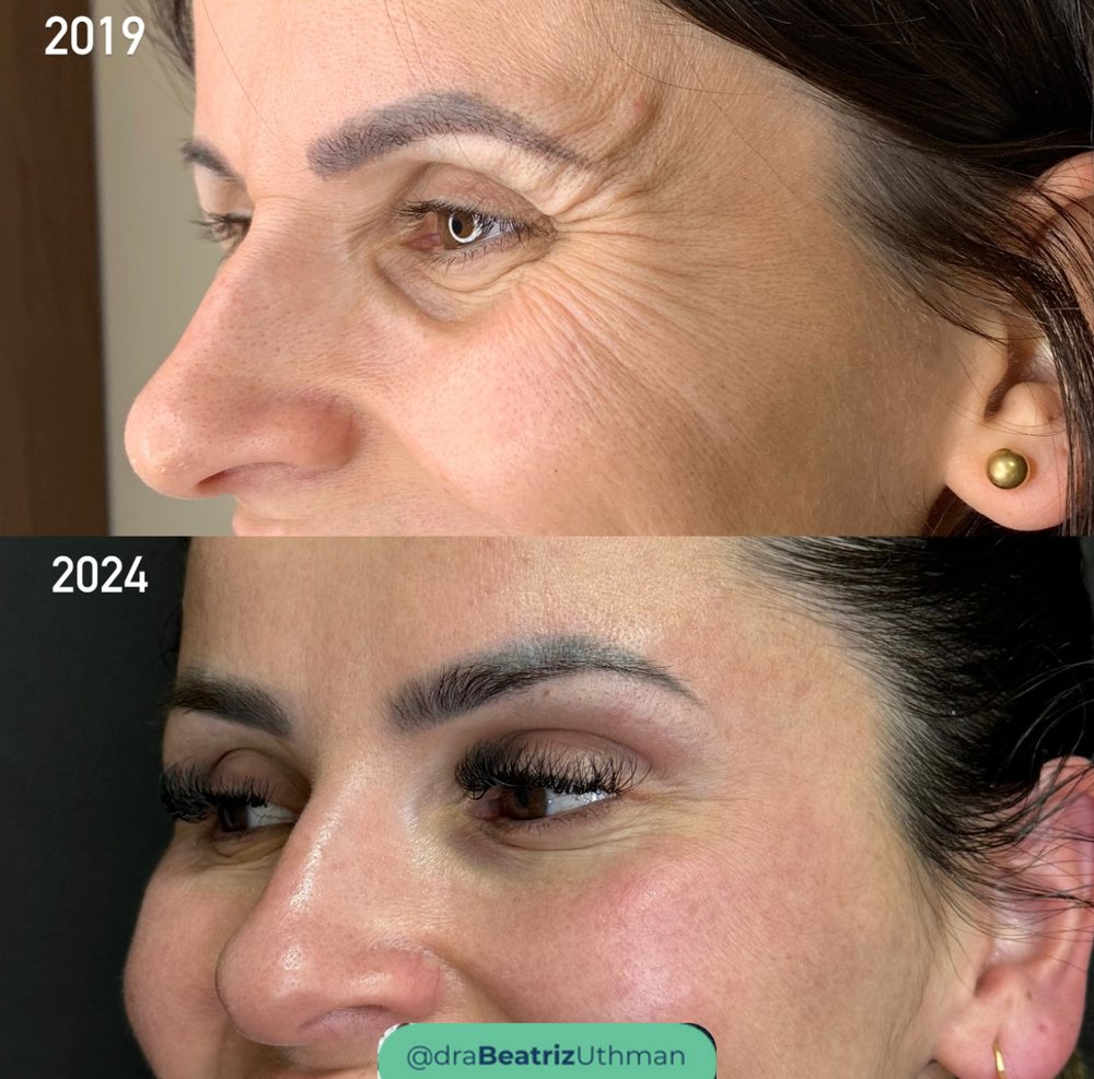 Ultraformer · Caso 6: antes e depois